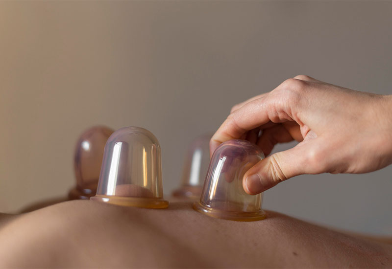 Back-of-a-person-with-cups-for-cuping-therapy