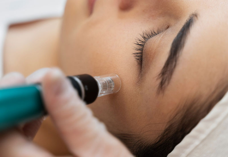 A close-up image of a woman undergoing a microneedling treatment on her face. A practitioner, wearing gloves, is using a microneedling device on her cheek near her closed eye. The woman's skin appears smooth and healthy, with soft lighting enhancing the details of the procedure in a clean, clinical setting.
